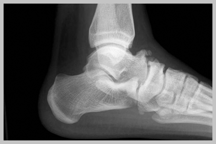 ankle dorsiflexion